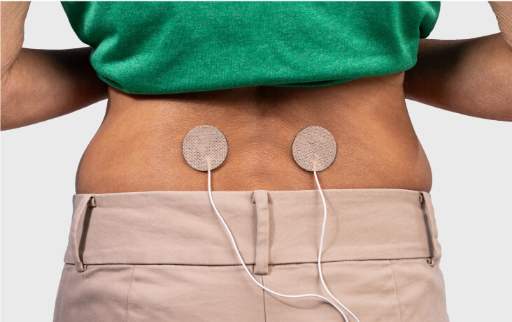 A female patient shows how the electrodes for the ActaStim bone growth stimulation system attach to her fusion site